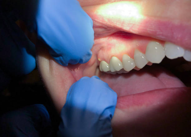 Best Emergency Denture Repair in Lawrenceburg, KY